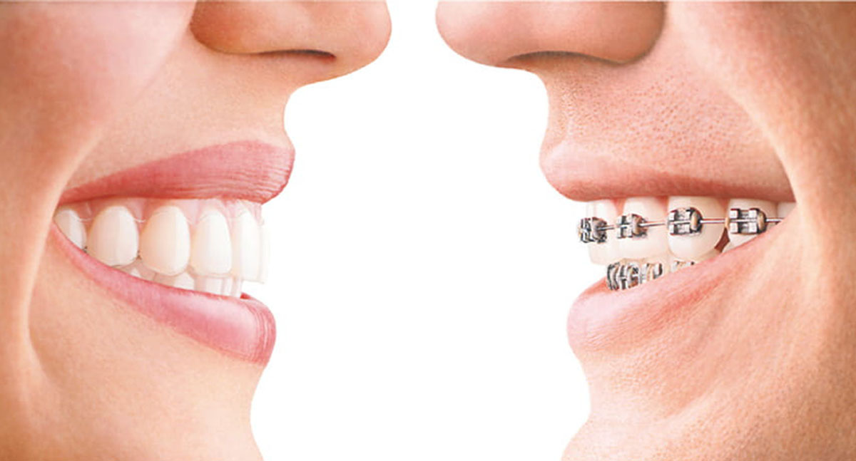 Invisalign vs. Traditional Braces: Which Is Right for You? - Dr. Sidharth Shah