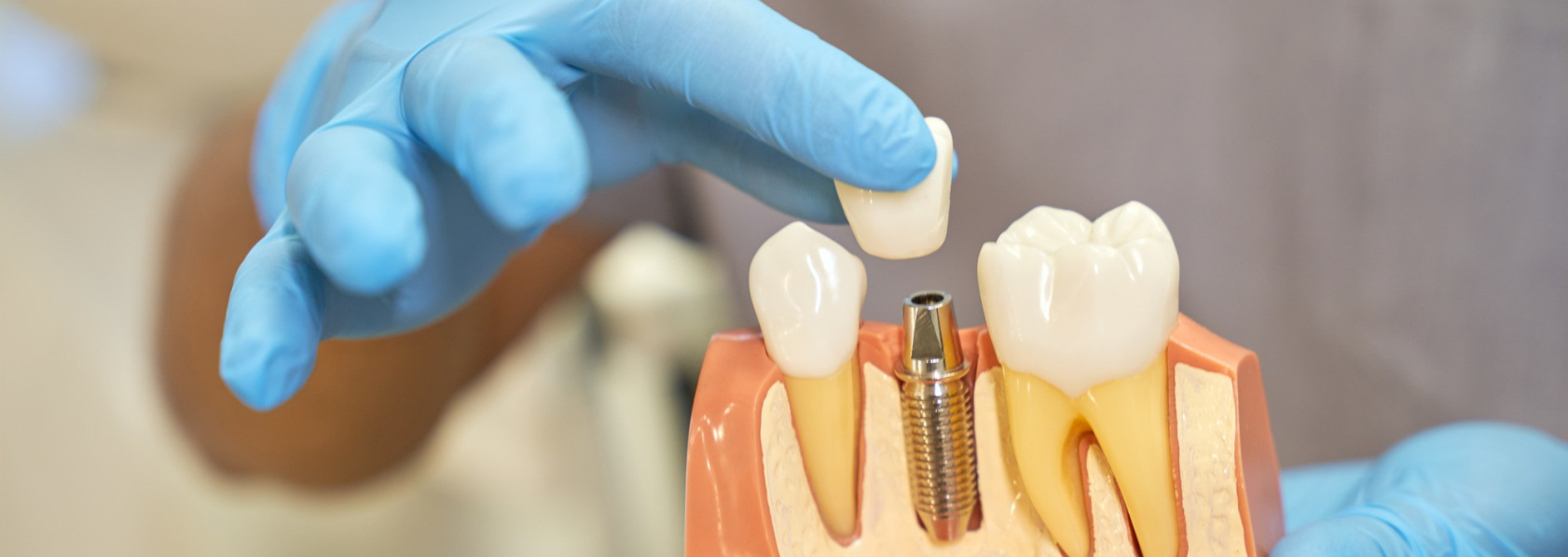 Dental Implant