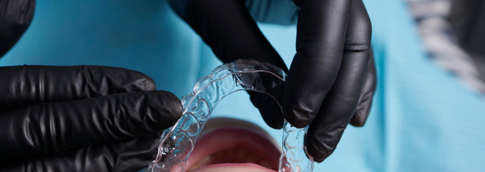 Invisalign treatment