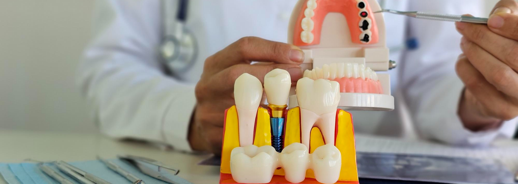 Dental Implant Treatment
