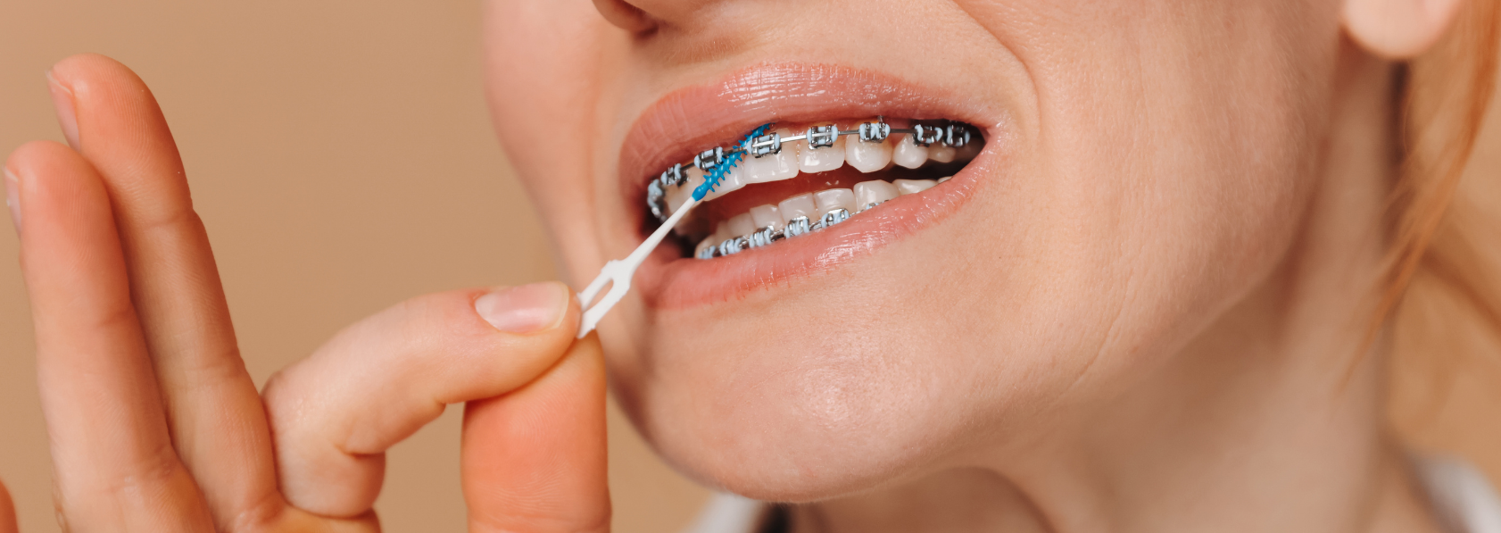 Oral Hygiene with Braces