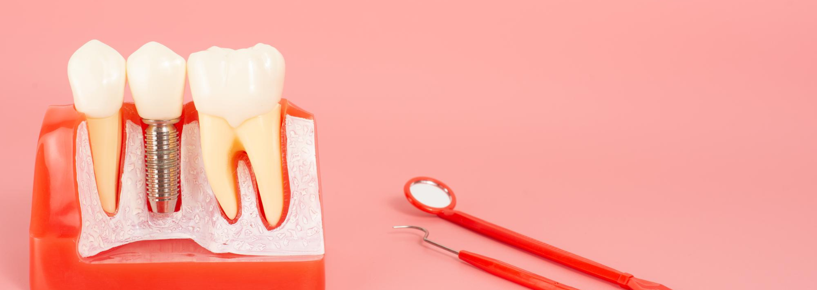Dental Implant Candidate