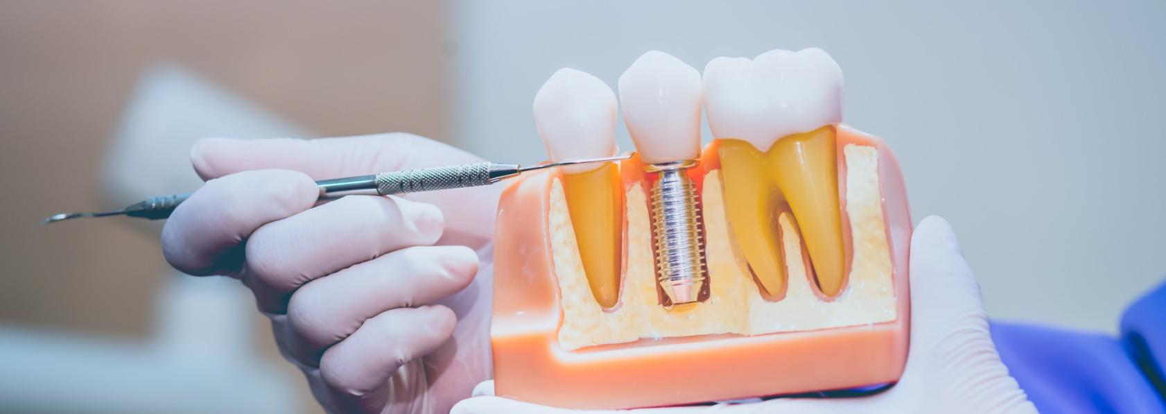 Dental Implant tips