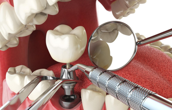 Dental Implant Care