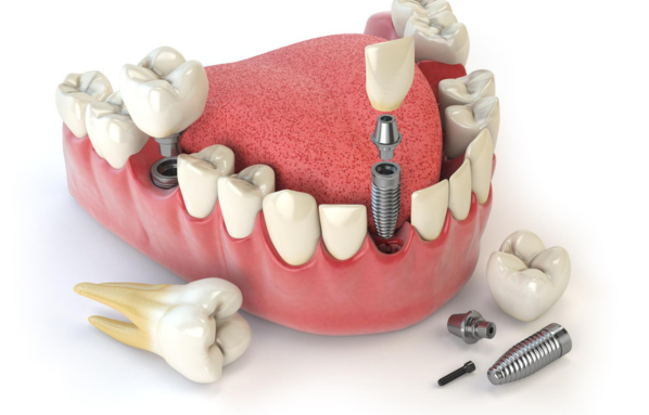 Dental Implant