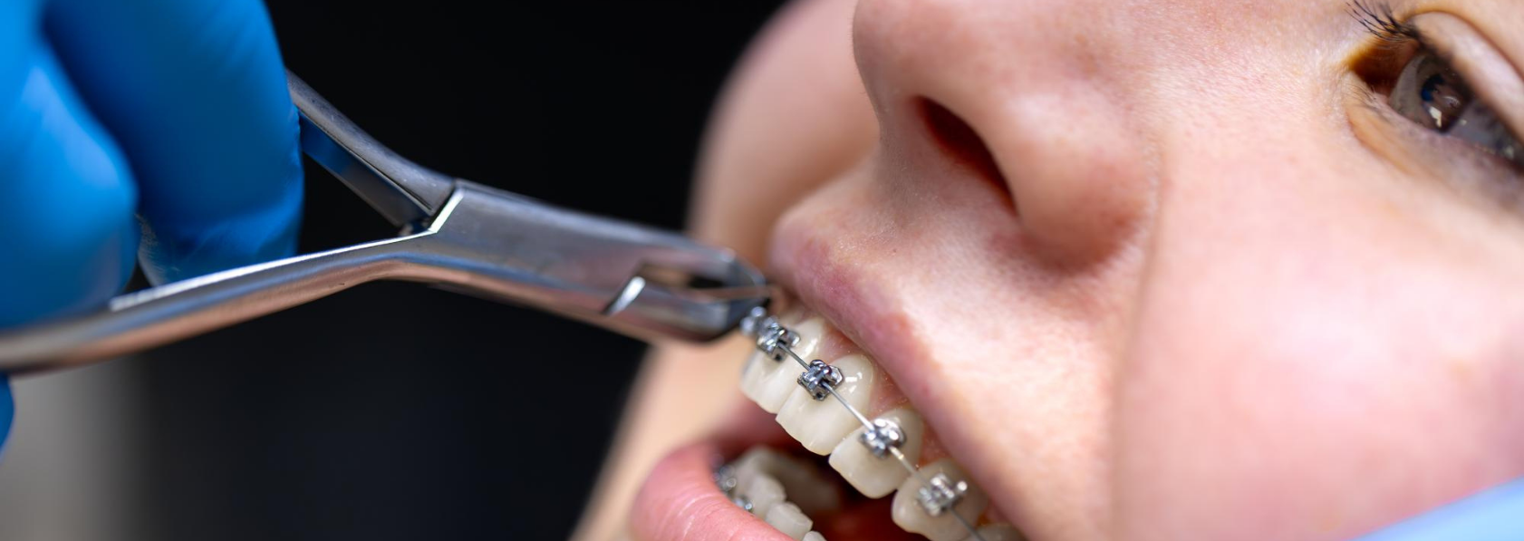Metal Braces
