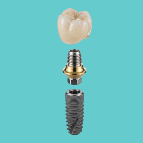 Dental Implant