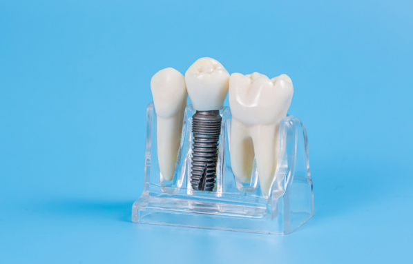 dental implant for a broken tooth