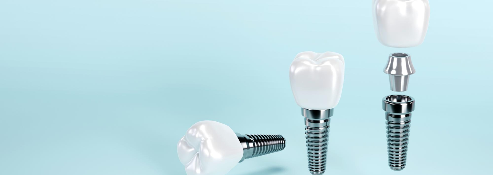 Dental Implant for a Broken Tooth