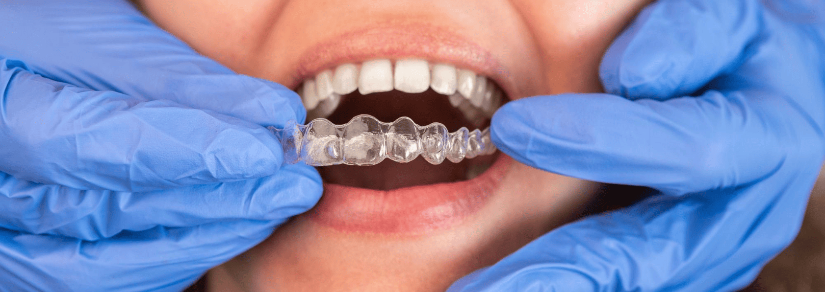 Invisalign Treatment