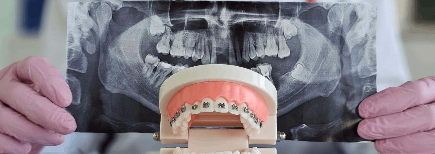 Braces Treatment