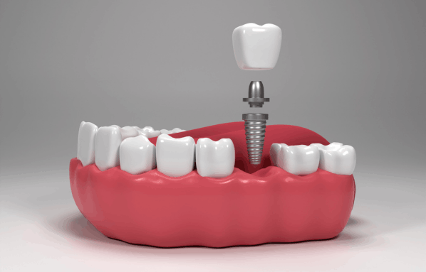 Dental Implant Treatment