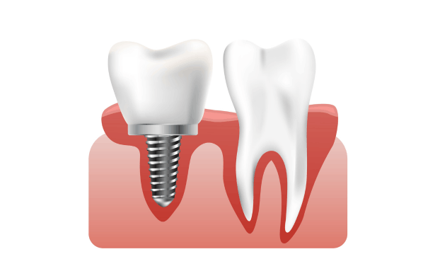 Dental Implant