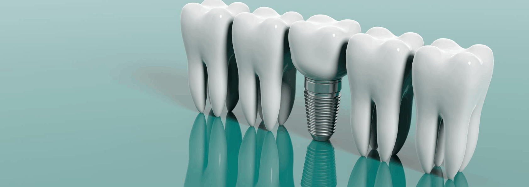 Dental implant Treatment