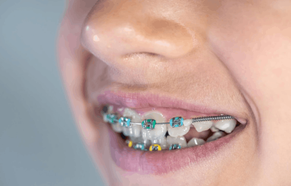 Braces Treatment