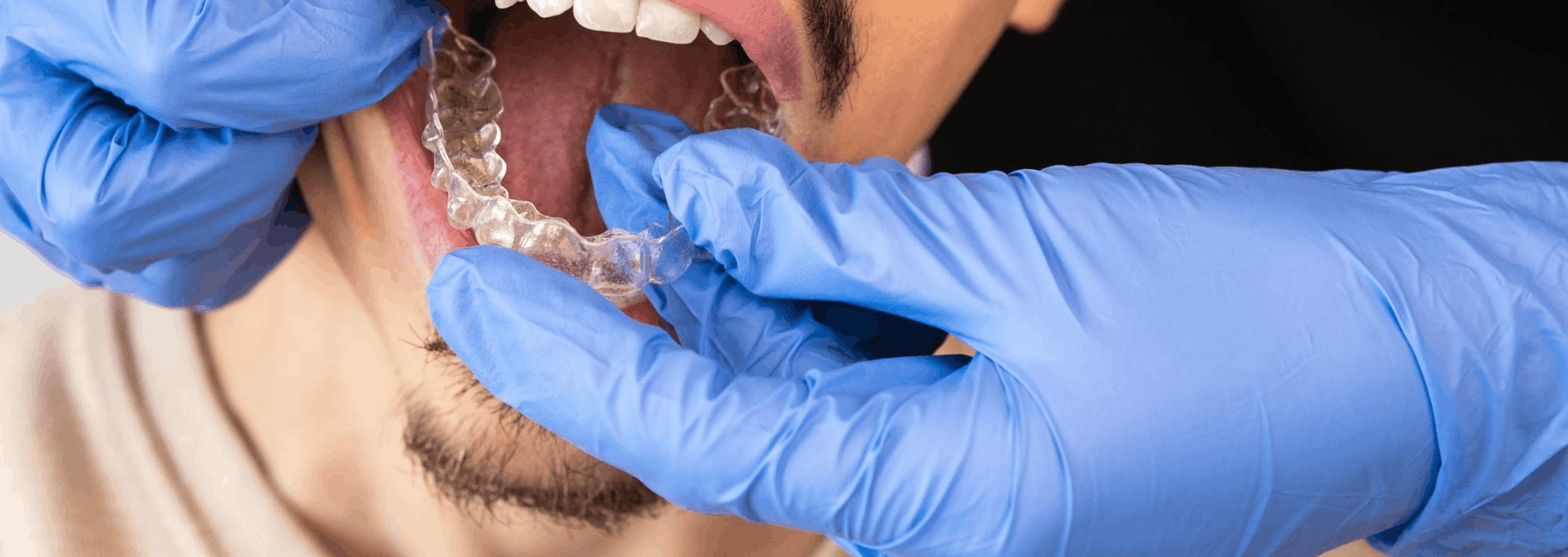 Invisalign Treatment