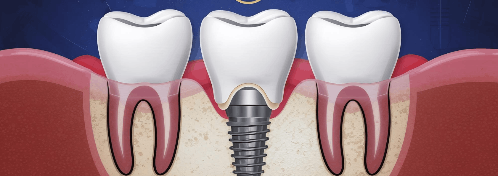 Dental Implant
