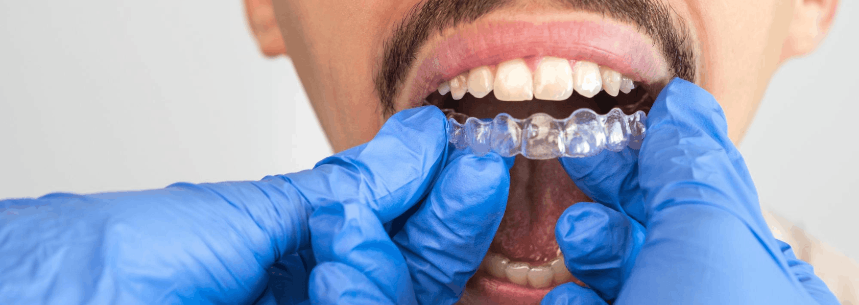 Invisalign Aligners