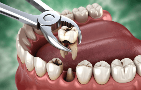 Dental Implat